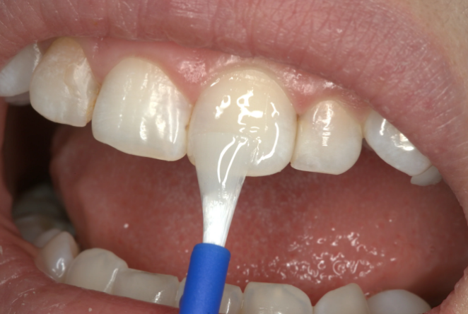 فلوراید تراپی در مطب دندانپزشکی برای پیشگیری از نیاز به عصبکشی و  پوسیدگی