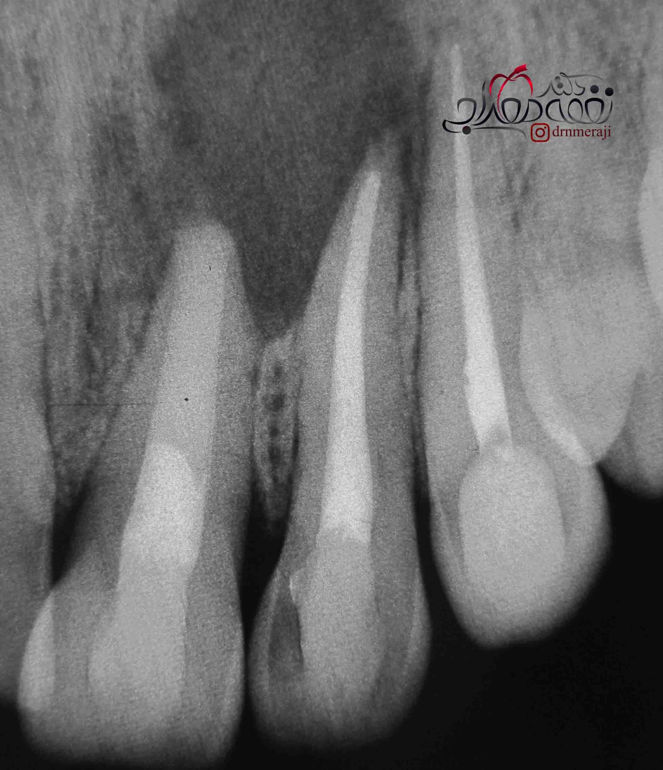 خدمات مطب دکتر نغمه معراجی درمان دندان با ریشه ناکامل و باز