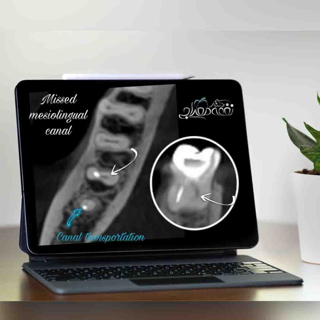 استفاده از تصویربرداری پیشرفته CBCT