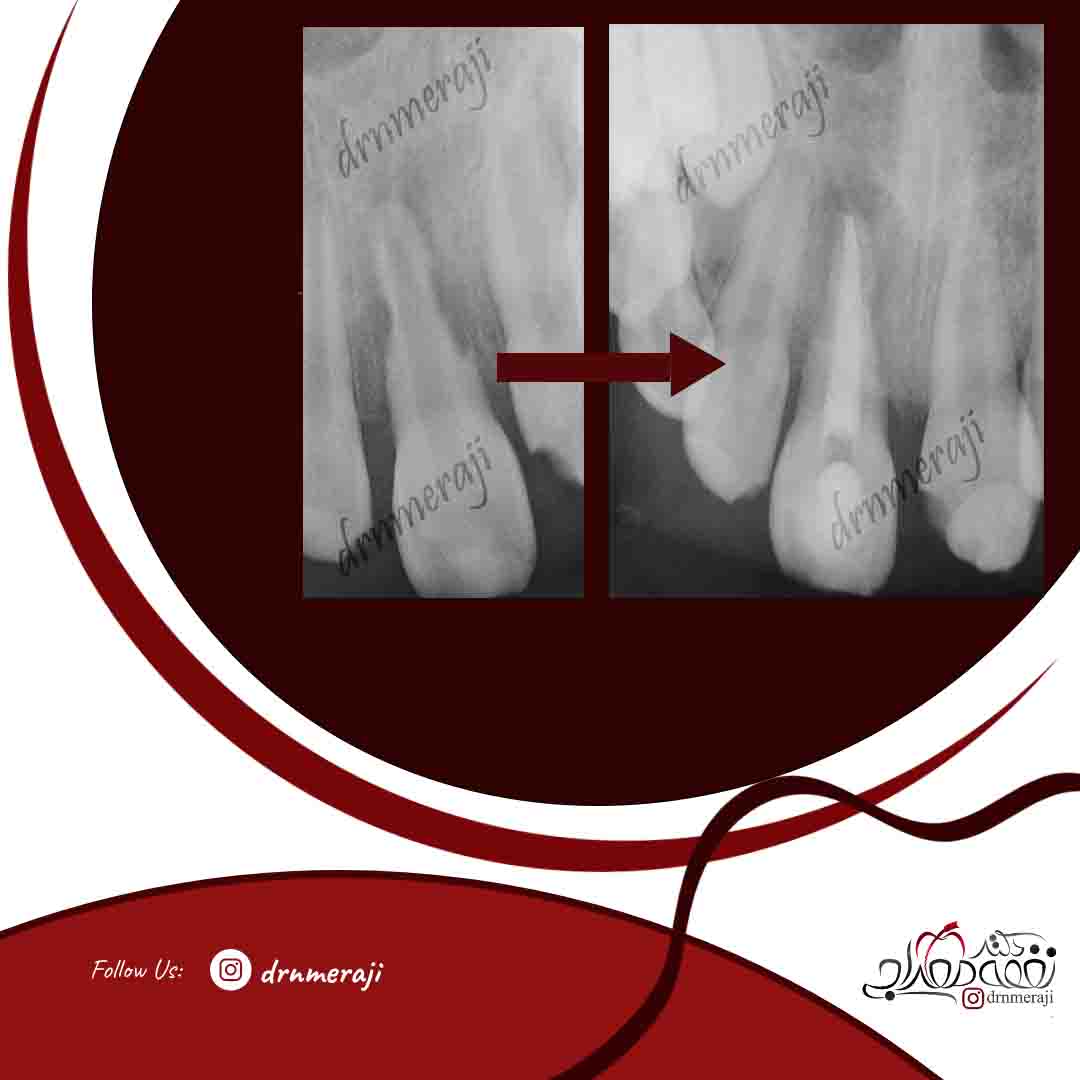 درمان ریشه دندان با تحلیل خارجی ریشه