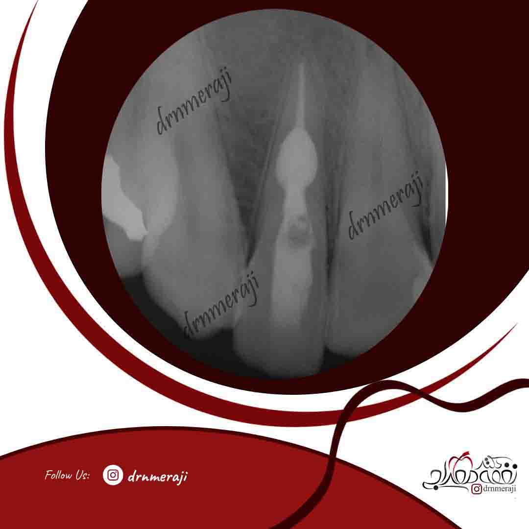 درمان ریشه دندان با تحلیل داخلی ریشه