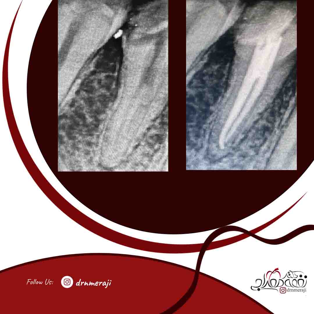 درمان ریشه دندان با کانال اضافه