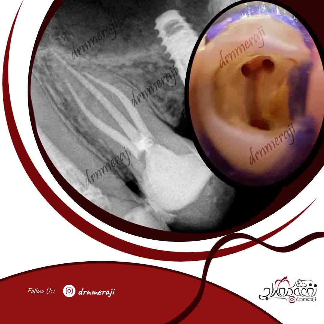 درمان ریشه تخصصی دندان با کانال و ریشه اضافی