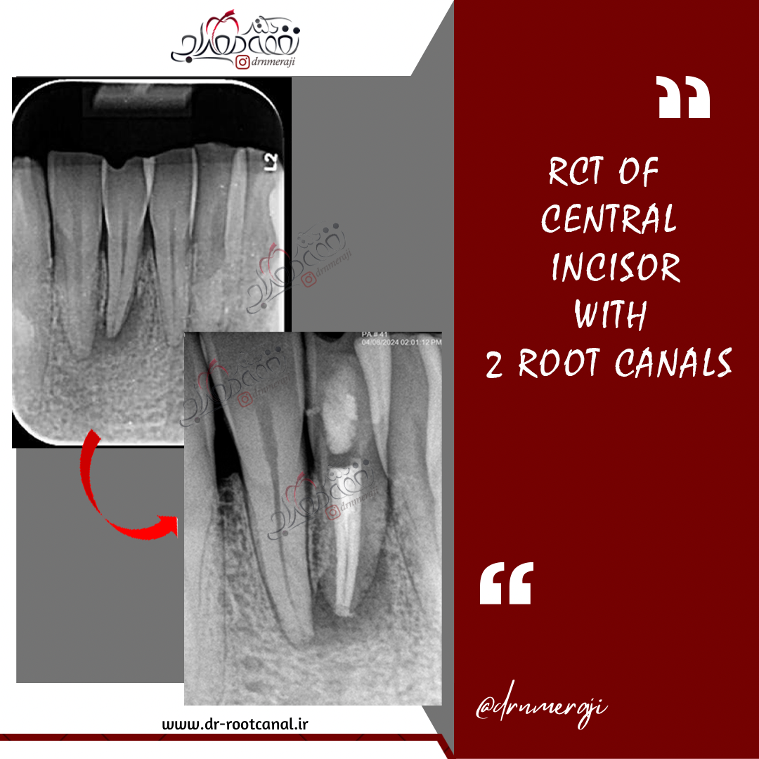 درمان ریشه دندان با کانال اضافی