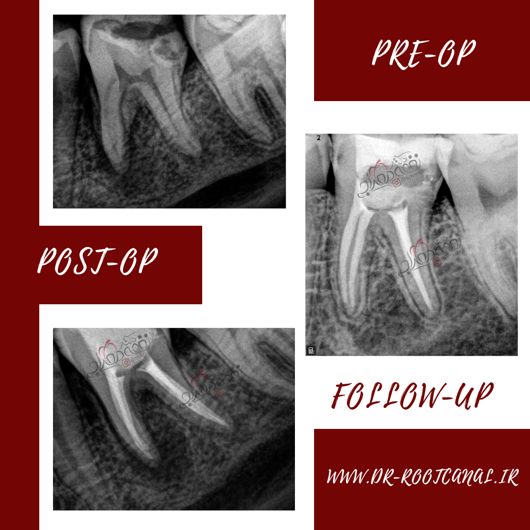 بهبود ضایعه و عفونت دندان با درمان ریشه مناسب 